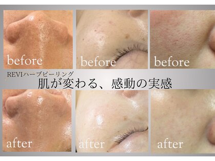 肌質改善専門Salon72 【ハーブピーリング/毛穴/シミ/たるみ/ニキビ改善】の写真