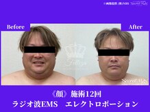 フェレザ 新潟(Felleza)/エレクトロポレーション