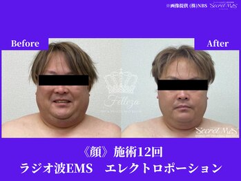 フェレザ 新潟(Felleza)/エレクトロポレーション