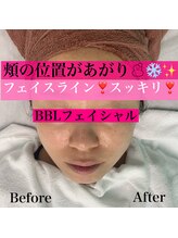 ハニーアイズ(Honey Eyes)/【BBLフェイシャル体験】