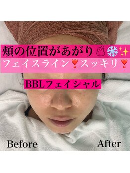ハニーアイズ(Honey Eyes)/【BBLフェイシャル体験】