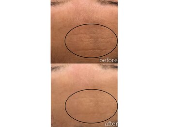 モニ 福岡(Moni)/ハーブピーリング で シワケア