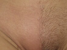 毛量に関係なくその場で無くなり衛生的でニオイ蒸れ対策にも^ ^