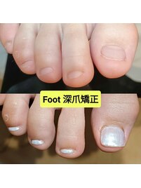 フットの深爪矯正/フットバス