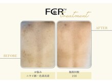 ハーバル 新宿店(HERBAL)/最強★韓国FCRハーブピーリング