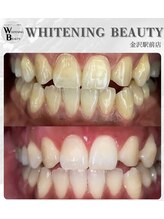 ホワイトニングビューティー 金沢駅前店(WHITENING BEAUTY)/短期間で真っ白に！