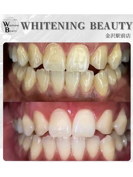 ホワイトニングビューティー 金沢駅前店(WHITENING BEAUTY)/短期間で真っ白に!