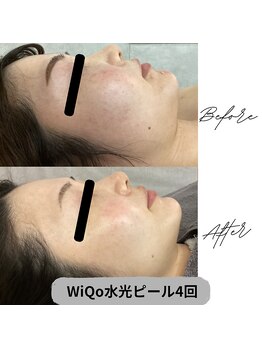 プレジール 大野城店(plaisir)/WiQo水光ピール