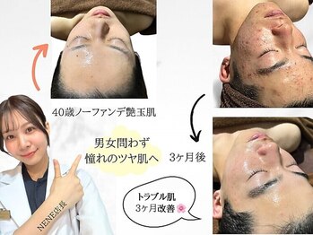 セレブリボーン 大阪ボーテ/セルマンピーリング