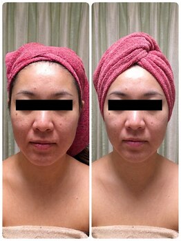 プティ ニド(Petit Nid)の写真/【1度で変化！本気の小顔ケア】むくみ・滞りを改善→パーツをあるべき所へ戻せばこんなに見違える印象に☆