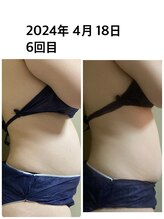 ブリリアント(Brilliant)/お腹周り通い放題６回目（痩身）