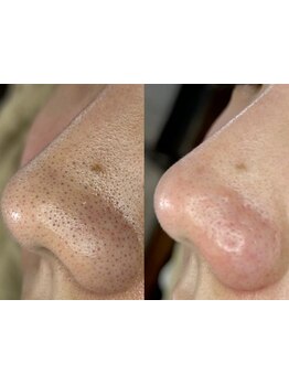 毛穴ケアをしたい