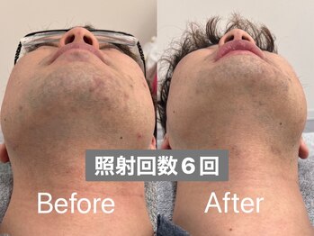 ラトリエ(L'Atelier)/ヒゲ脱毛6回 ビフォー/アフター