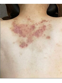 リベル 名古屋(Lebelle:)/ハーブピーリング専門 名古屋