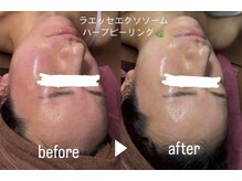 ナルシス(Narcissus)/エクソソームハーブピーリング