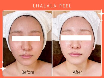 ハノハノ 八代店(HANO HANO)/韓国肌管理ララピール☆