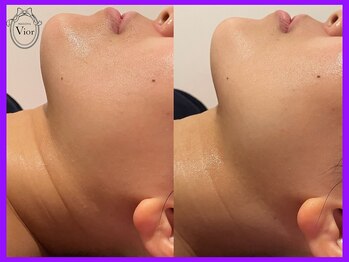 ヴィオール 名古屋栄店(VIOR)/キュっと引き締まった美ラインへ