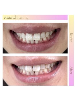 エクシアホワイトニング 天王寺店/ホワイトニングビフォーアフター