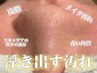 極ヘッドスパ&デコルテマッサージ付★韓国式毛穴洗浄¥16,500→¥12,800所要90