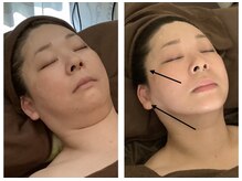アクア エステティコ 亀有(ACQUA estetico)の雰囲気（小顔フェイシャル、デコルテ首集中ケアフェイシャル1年経過）