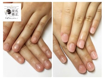 トイロ(toiro)/「爪質改善」「自爪再生」が叶う