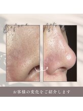 肌イズム 守谷店(肌ism)/毛穴ビフォーアフター