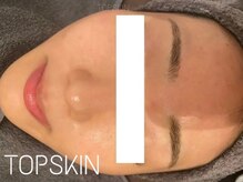 トップスキン 名駅(TOPSKIN)/ニキビ肌卒業！肌荒れのない艶肌