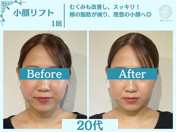 フローフシ∞/【小顔】切らない小顔リフト