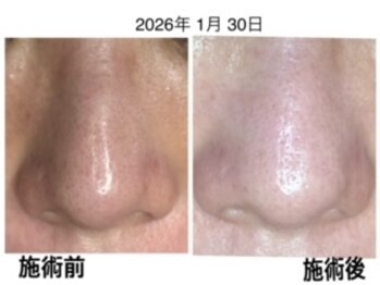 ミント/毛穴もお肌の手をぬかない