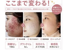 ブプラ 沖縄那覇店(BUPURA)の雰囲気(毛穴,たるみケア,ニキビケア等のお肌悩みには"ハーブピーリング")