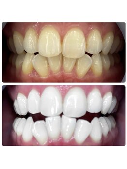 ラブホワイトニング 渋谷店(LOVEホワイトニング)/ラブホワイトニング