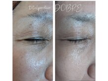 ドブレ(DOBRE)/まぶたのたるみがお悩みの方へ