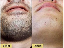 レ サロン(les SALON)/結果重視の脱毛/メンズ脱毛/奈良