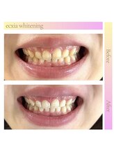 エクシアホワイトニング 天王寺店/ホワイトニングビフォーアフター