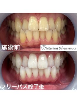 ホワイトニングサロン 京都烏丸店/ホワイトニング施術例