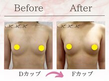 エムエムエム 表参道Luxeサロン(M.M.M)/【バストアップ例】　D→Fカップ