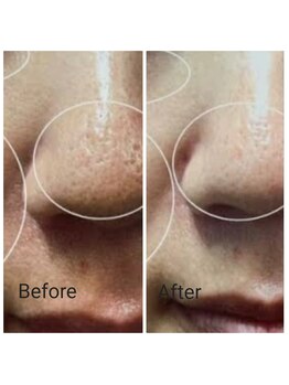 サロン ピューパ(Salon pupa)/女性毛穴洗浄　before→after