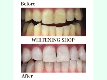 ホワイトニングショップ 守口店/before／After　16トーンUP