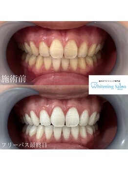 ホワイトニングサロン 熊本店/街中ホワイトニング