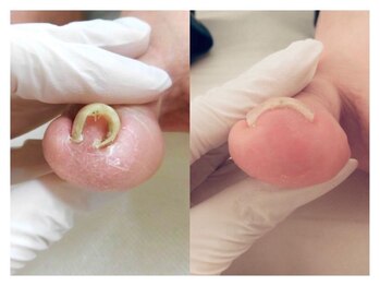 巻き爪ケアサポート ルアナ(LUANA)/Before→After