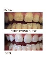 ホワイトニングショップ 霧島店/美白ホワイトニング