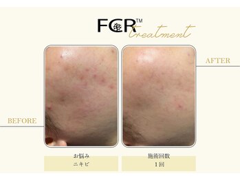 ハーバル 新宿店(HERBAL)/最強★韓国FCRハーブピーリング