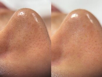 フェリス(FELIZ)/韓国式3D毛穴洗浄+シルク洗顔