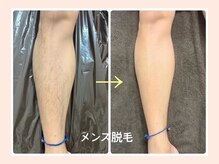 リファイン(REFINE)/メンズ脱毛もご相談下さい！