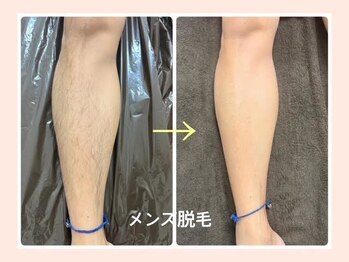 リファイン(REFINE)/メンズ脱毛もご相談下さい！