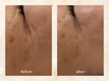 セーラマーレ(cera-mare Esthetic by CARDIA)/ララピールリフト