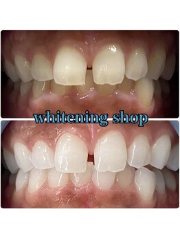 ホワイトニングショップ 池田店/【BEFORE/AFTER】