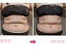 ★即実感！効果は半永久【ぜい肉サヨナラ】《韓国レッドショット痩身》￥11000