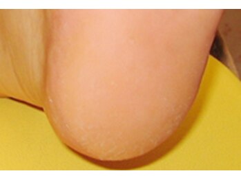 今日はいい日だセラピールーム (Room)/角質ケア