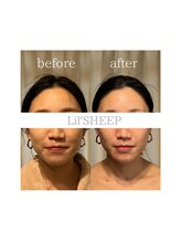 リルシープ(LIL'SHEEP)/眠れる小顔コルギ1回施術